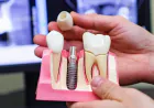 Diş eksikliğinde implant tedavisi: Kimler için uygun?